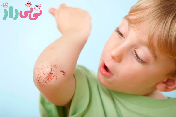 زخمهای بدن خردسالان را چگونه باید ترمیم کنیم؟